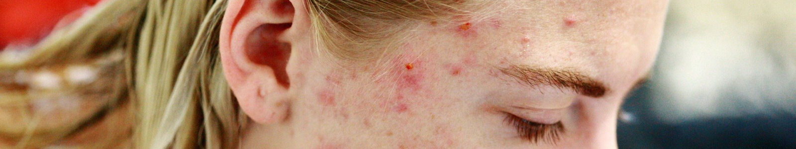 Comment lutter contre l'acné?